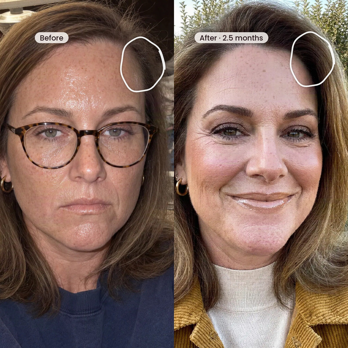 Before and after two and a half months: the same woman, her temple looked thin before and her hairline looked fuller after